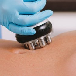 Radiofrequency (RF) Therapy - 12 Sessions