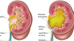 Kidney Stones-How to reduce your risk