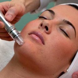 Microdermabrasion with Facial