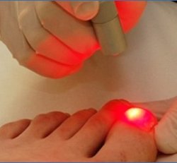 Laser (Nail Fungus)