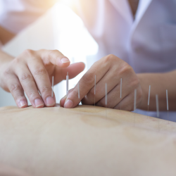 Acupuncture - 60 minutes