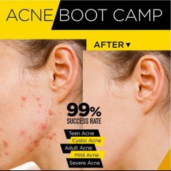 Acne Boot Camp Membership
